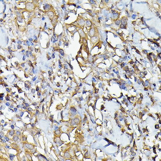 Immunohistochemistry: Caspase-4 Antibody [NBP3-35895] - Immunohistochemistry analysis of paraffin-embedded Human breast cancer using Caspase-4 Rabbit pAb at dilution of 1:50 (40x lens). High pressure antigen retrieval performed with 0.01M Citrate Bufferr (pH 6.0) prior to IHC staining.