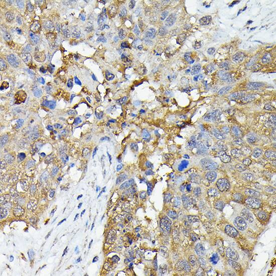 Immunohistochemistry: Caspase-4 Antibody [NBP3-35895] - Immunohistochemistry analysis of paraffin-embedded Human lung cancer using Caspase-4 Rabbit pAb at dilution of 1:50 (40x lens). High pressure antigen retrieval performed with 0.01M Citrate Bufferr (pH 6.0) prior to IHC staining.