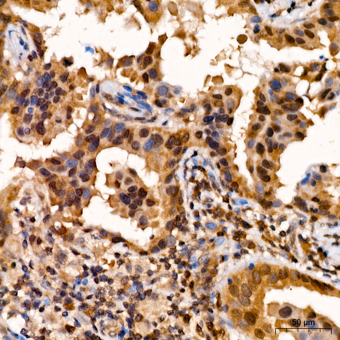 Immunohistochemistry: PSMB5 Antibody [NBP3-35905] - Immunohistochemistry analysis of PSMB5 in paraffin-embedded human breast tissue using PSMB5 Rabbit pAb at a dilution of 1:600 (40x lens). High pressure antigen retrieval was performed with 0.01 M citrate buffer (pH 6.0) prior to IHC staining.