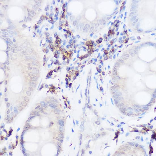 Immunohistochemistry: Thromboxane synthase Antibody [NBP3-35910] - Immunohistochemistry analysis of paraffin-embedded Human colon carcinoma using Thromboxane synthase Rabbit pAb at dilution of 1:50 (40x lens). High pressure antigen retrieval performed with 0.01M Citrate Bufferr (pH 6.0) prior to IHC staining.