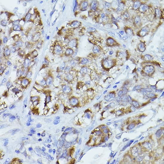 Immunohistochemistry: CPT2 Antibody [NBP3-36715] - Immunohistochemistry analysis of paraffin-embedded Human liver cancer using CPT2 Rabbit pAb at dilution of 1:100 (40x lens). High pressure antigen retrieval performed with 0.01M Citrate Bufferr (pH 6.0) prior to IHC staining.