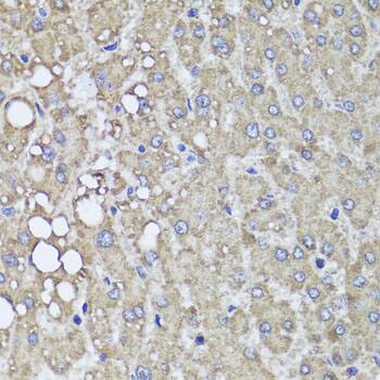 Immunohistochemistry: PIK3C2A Antibody [NBP3-37948] - Immunohistochemistry analysis of paraffin-embedded Human liver damage using PIK3C2A Rabbit pAb at dilution of 1:100 (40x lens). Microwave antigen retrieval performed with 0.01M PBS Buffer (pH 7.2) prior to IHC staining.