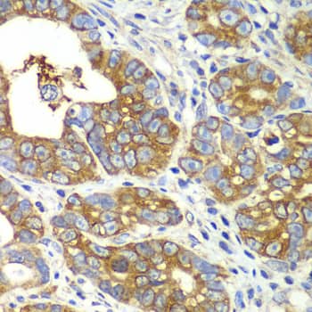 Immunohistochemistry: QARS Antibody [NBP3-37952] - Immunohistochemistry analysis of paraffin-embedded Human gastric cancer using QARS Rabbit pAb at dilution of 1:100 (40x lens). Microwave antigen retrieval performed with 0.01M PBS Buffer (pH 7.2) prior to IHC staining.