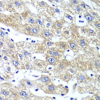 Immunohistochemistry: QARS Antibody [NBP3-37952] - Immunohistochemistry analysis of paraffin-embedded Human liver damage using QARS Rabbit pAb at dilution of 1:100 (40x lens). Microwave antigen retrieval performed with 0.01M PBS Buffer (pH 7.2) prior to IHC staining.