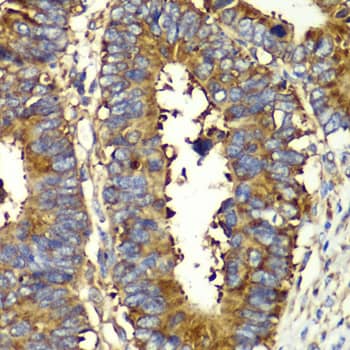 Immunohistochemistry: QARS Antibody [NBP3-37952] - Immunohistochemistry analysis of paraffin-embedded Human colon carcinoma using QARS Rabbit pAb at dilution of 1:100 (40x lens). Microwave antigen retrieval performed with 0.01M PBS Buffer (pH 7.2) prior to IHC staining.