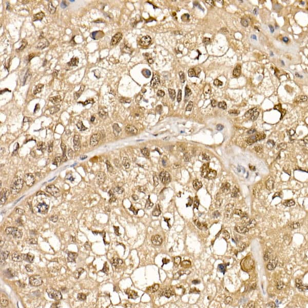 Immunohistochemistry: Cullin 1 Antibody [NBP3-37968] - Immunohistochemistry analysis of paraffin-embedded Human lung cancer using Cullin 1 Rabbit pAb at dilution of 1:50 (40x lens). High pressure antigen retrieval performed with 0.01M Citrate Bufferr (pH 6.0) prior to IHC staining.