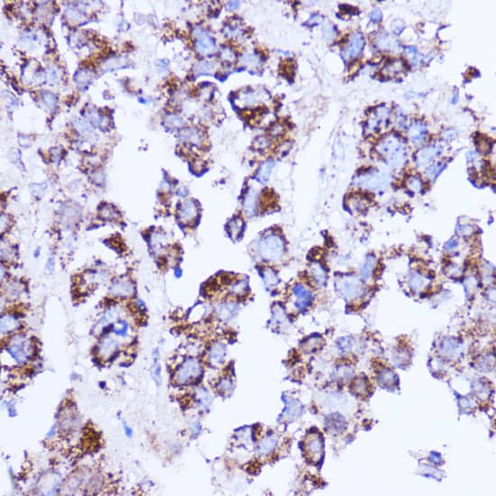 Immunohistochemistry: SHMT2 Antibody [NBP3-37977] - Immunohistochemistry analysis of paraffin-embedded Human liver cancer using SHMT2 Rabbit pAb at dilution of 1:100 (40x lens). Microwave antigen retrieval performed with 0.01M PBS Buffer (pH 7.2) prior to IHC staining.