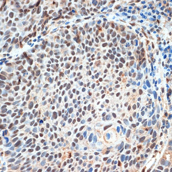 Immunohistochemistry: JMJD1B Antibody [NBP3-37990] - Immunohistochemistry analysis of paraffin-embedded Human esophageal cancer using JMJD1B Rabbit pAb at dilution of 1:100 (40x lens). Microwave antigen retrieval performed with 0.01M Tris/EDTA Buffer (pH 9.0) prior to IHC staining.