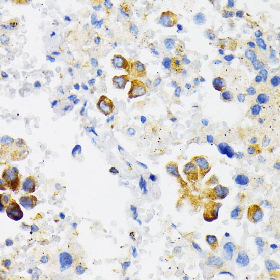 Immunohistochemistry: VDP p115 Antibody [NBP3-38014] - Immunohistochemistry analysis of paraffin-embedded Human lung cancer using VDP p115 Rabbit pAb at dilution of 1:100 (40x lens). Microwave antigen retrieval performed with 0.01M PBS Buffer (pH 7.2) prior to IHC staining.