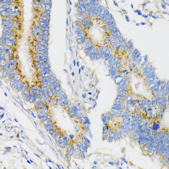 Immunohistochemistry: VDP p115 Antibody [NBP3-38014] - Immunohistochemistry analysis of paraffin-embedded Human colon carcinoma using VDP p115 Rabbit pAb at dilution of 1:100 (40x lens). Microwave antigen retrieval performed with 0.01M PBS Buffer (pH 7.2) prior to IHC staining.