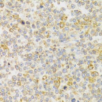 Immunohistochemistry: KiSS1R/GPR54 Antibody [NBP3-38024] - Immunohistochemistry analysis of paraffin-embedded Human B cell lymphoma using KiSS1R/GPR54 Rabbit pAb at dilution of 1:100 (40x lens). Microwave antigen retrieval performed with 0.01M PBS Buffer (pH 7.2) prior to IHC staining.