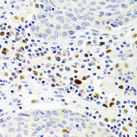 Immunohistochemistry: GEMIN2 Antibody [NBP3-38028] - Immunohistochemistry analysis of paraffin-embedded Human lung cancer using GEMIN2 Rabbit pAb at dilution of 1:100 (40x lens). Microwave antigen retrieval performed with 0.01M PBS Buffer (pH 7.2) prior to IHC staining.