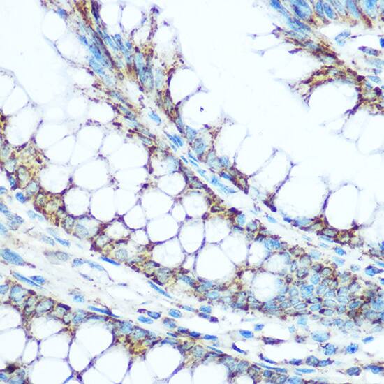 Immunohistochemistry: UQCRC1 Antibody [NBP3-38038] - Immunohistochemistry analysis of paraffin-embedded Human colon using UQCRC1 Rabbit pAb at dilution of 1:100 (40x lens). Microwave antigen retrieval performed with 0.01M Tris/EDTA Buffer (pH 9.0) prior to IHC staining.