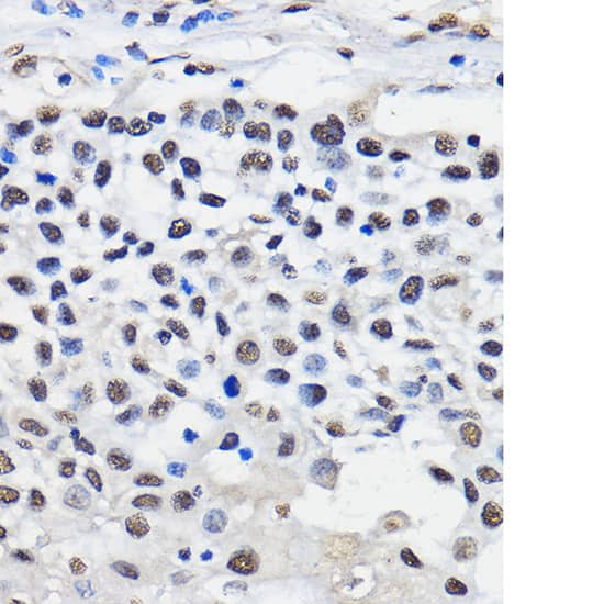 Immunohistochemistry: hnRNP U Antibody [NBP3-38059] - Immunohistochemistry analysis of paraffin-embedded Human esophageal cancer using hnRNP U Rabbit pAb at dilution of 1:50 (40x lens). Microwave antigen retrieval performed with 0.01M PBS Buffer (pH 7.2) prior to IHC staining.