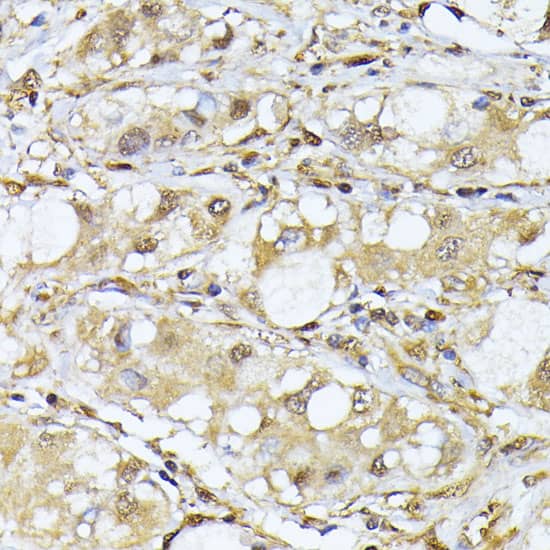 Immunohistochemistry: PSMA7 Antibody [NBP3-38071] - Immunohistochemistry analysis of paraffin-embedded Human liver cancer using PSMA7 Rabbit pAb at dilution of 1:100 (40x lens). Microwave antigen retrieval performed with 0.01M PBS Buffer (pH 7.2) prior to IHC staining.