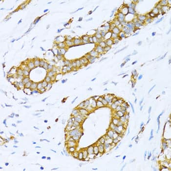 Immunohistochemistry: VARS Antibody [NBP3-38079] - Immunohistochemistry analysis of paraffin-embedded Human breast cancer using VARS Rabbit pAb at dilution of 1:100 (40x lens). Microwave antigen retrieval performed with 0.01M PBS Buffer (pH 7.2) prior to IHC staining.