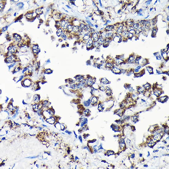 Immunohistochemistry: Isopeptidase T/USP5 Antibody [NBP3-38080] - Immunohistochemistry analysis of paraffin-embedded Human lung cancer using Isopeptidase T/USP5 Rabbit pAb at dilution of 1:100 (40x lens). High pressure antigen retrieval performed with 0.01M Citrate Bufferr (pH 6.0) prior to IHC staining.