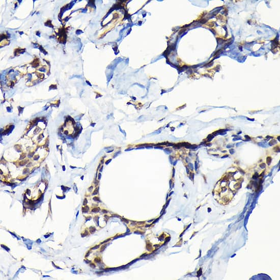 Immunohistochemistry: Isopeptidase T/USP5 Antibody [NBP3-38080] - Immunohistochemistry analysis of paraffin-embedded Human breast cancer using Isopeptidase T/USP5 Rabbit pAb at dilution of 1:100 (40x lens). High pressure antigen retrieval performed with 0.01M Citrate Bufferr (pH 6.0) prior to IHC staining.