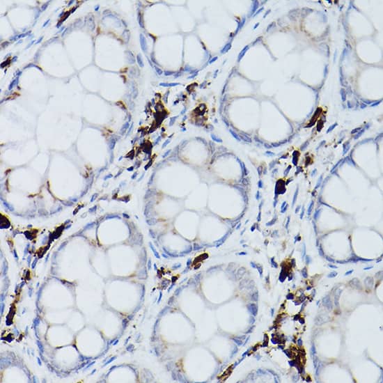 Immunohistochemistry: UbcH8/Ube2L6 Antibody [NBP3-38084] - Immunohistochemistry analysis of paraffin-embedded Human colon carcinoma using UbcH8/Ube2L6 Rabbit pAb at dilution of 1:200 (40x lens). Microwave antigen retrieval performed with 0.01M PBS Buffer (pH 7.2) prior to IHC staining.