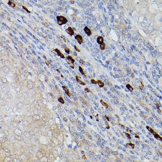 Immunohistochemistry: UbcH8/Ube2L6 Antibody [NBP3-38084] - Immunohistochemistry analysis of paraffin-embedded Human breast cancer using UbcH8/Ube2L6 Rabbit pAb at dilution of 1:200 (40x lens). Microwave antigen retrieval performed with 0.01M PBS Buffer (pH 7.2) prior to IHC staining.