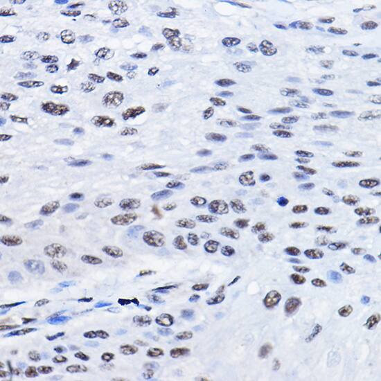 Immunohistochemistry: BCAS2 Antibody [NBP3-38090] - Immunohistochemistry analysis of paraffin-embedded Human esophageal cancer using BCAS2 Rabbit pAb at dilution of 1:100 (40x lens). High pressure antigen retrieval performed with 0.01M Citrate Bufferr (pH 6.0) prior to IHC staining.