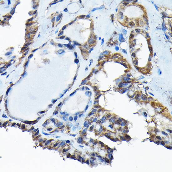Immunohistochemistry: RBBP9 Antibody [NBP3-38095] - Immunohistochemistry analysis of paraffin-embedded Human thyroid cancer using RBBP9 Rabbit pAb at dilution of 1:200 (40x lens). High pressure antigen retrieval performed with 0.01M Citrate Bufferr (pH 6.0) prior to IHC staining.