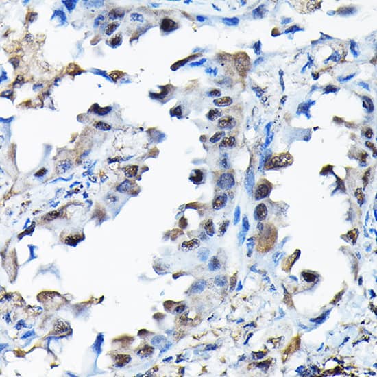 Immunohistochemistry: RBBP9 Antibody [NBP3-38095] - Immunohistochemistry analysis of paraffin-embedded Human lung cancer using RBBP9 Rabbit pAb at dilution of 1:200 (40x lens). High pressure antigen retrieval performed with 0.01M Citrate Bufferr (pH 6.0) prior to IHC staining.