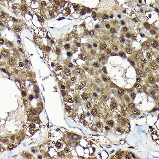 Immunohistochemistry: ADRM1 Antibody [NBP3-38097] - Immunohistochemistry analysis of paraffin-embedded Human liver cancer using ADRM1 Rabbit pAb at dilution of 1:100 (40x lens). High pressure antigen retrieval performed with 0.01M Citrate Bufferr (pH 6.0) prior to IHC staining.