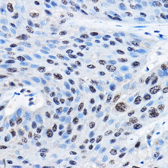 Immunohistochemistry: NUDT21 Antibody [NBP3-38098] - Immunohistochemistry analysis of paraffin-embedded Human esophageal cancer using NUDT21 Rabbit pAb at dilution of 1:100 (40x lens). High pressure antigen retrieval performed with 0.01M Citrate Bufferr (pH 6.0) prior to IHC staining.