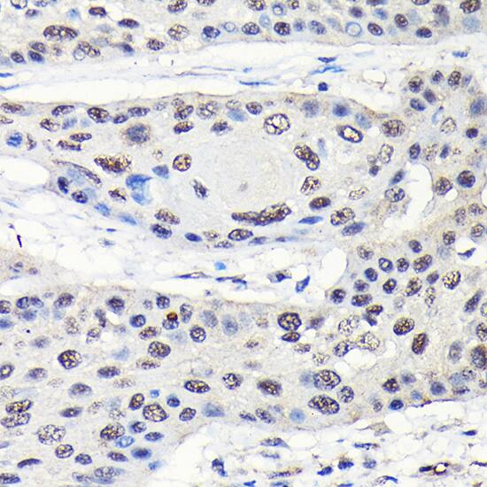 Immunohistochemistry: GTPBP4 Antibody [NBP3-38104] - Immunohistochemistry analysis of paraffin-embedded Human esophageal cancer using GTPBP4 Rabbit pAb at dilution of 1:50 (40x lens). High pressure antigen retrieval performed with 0.01M Citrate Bufferr (pH 6.0) prior to IHC staining.