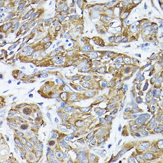 Immunohistochemistry: CC2D1A Antibody [NBP3-38114] - Immunohistochemistry analysis of paraffin-embedded Human esophageal cancer using CC2D1A Rabbit pAb at dilution of 1:200 (40x lens). High pressure antigen retrieval performed with 0.01M Citrate Bufferr (pH 6.0) prior to IHC staining.