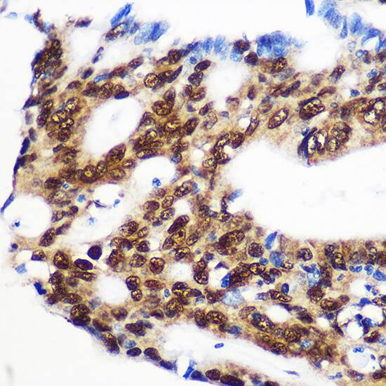 Immunohistochemistry: RBM15 Antibody [NBP3-38118] - Immunohistochemistry analysis of paraffin-embedded Human colon carcinoma using RBM15 Rabbit pAb at dilution of 1:100 (40x lens). Microwave antigen retrieval performed with 0.01M PBS Buffer (pH 7.2) prior to IHC staining.