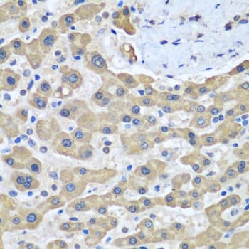 Immunohistochemistry: GFM1 Antibody [NBP3-38121] - Immunohistochemistry analysis of paraffin-embedded Human liver cancer using GFM1 Rabbit pAb at dilution of 1:100 (40x lens). Microwave antigen retrieval performed with 0.01M PBS Buffer (pH 7.2) prior to IHC staining.