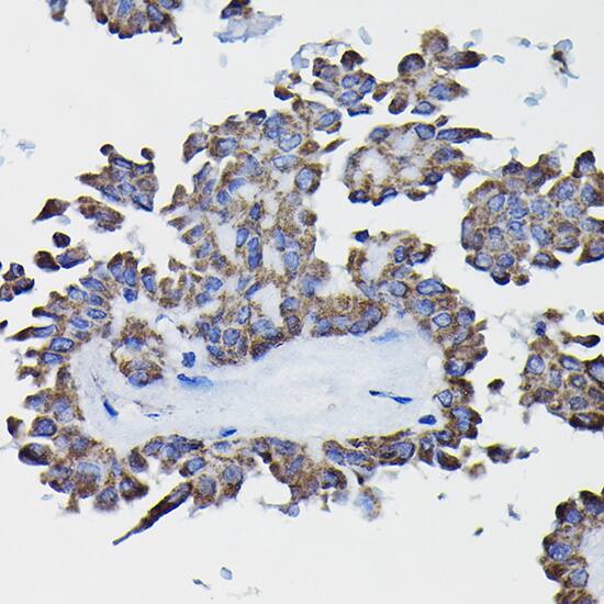 Immunohistochemistry: Glutathione S Transferase kappa 1 Antibody [NBP3-38128] - Immunohistochemistry analysis of paraffin-embedded Human thyroid cancer using Glutathione S Transferase kappa 1 Rabbit pAb at dilution of 1:20 (40x lens). High pressure antigen retrieval performed with 0.01M Citrate Bufferr (pH 6.0) prior to IHC staining.