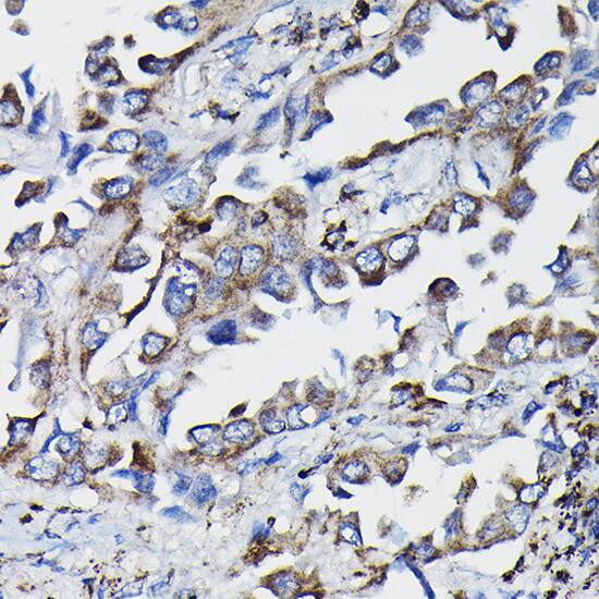 Immunohistochemistry: Glutathione S Transferase kappa 1 Antibody [NBP3-38128] - Immunohistochemistry analysis of paraffin-embedded Human lung cancer using Glutathione S Transferase kappa 1 Rabbit pAb at dilution of 1:20 (40x lens). High pressure antigen retrieval performed with 0.01M Citrate Bufferr (pH 6.0) prior to IHC staining.