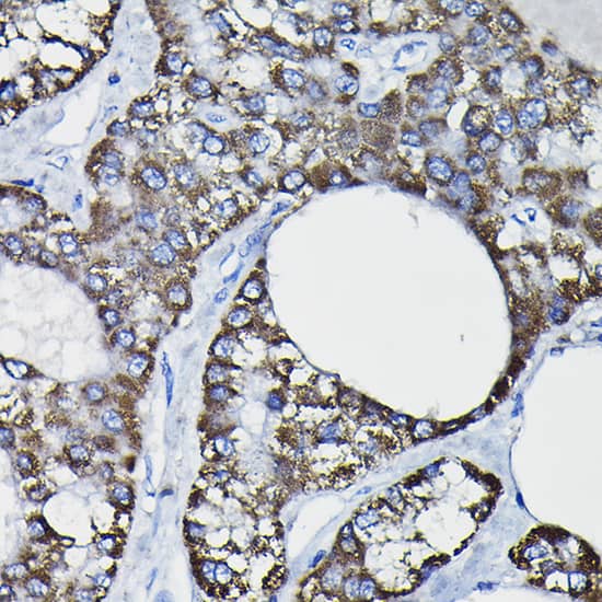 Immunohistochemistry: Glutathione S Transferase kappa 1 Antibody [NBP3-38128] - Immunohistochemistry analysis of paraffin-embedded Human liver cancer using Glutathione S Transferase kappa 1 Rabbit pAb at dilution of 1:20 (40x lens). High pressure antigen retrieval performed with 0.01M Citrate Bufferr (pH 6.0) prior to IHC staining.