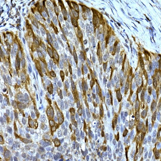 Immunohistochemistry: RRM2 Antibody [NBP3-38129] - Immunohistochemistry analysis of paraffin-embedded Human lung cancer using RRM2 Rabbit pAb at dilution of 1:100 (40x lens). High pressure antigen retrieval performed with 0.01M Citrate Bufferr (pH 6.0) prior to IHC staining.