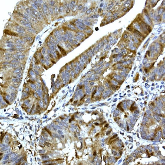 Immunohistochemistry: RRM2 Antibody [NBP3-38129] - Immunohistochemistry analysis of paraffin-embedded Human colon carcinoma using RRM2 Rabbit pAb at dilution of 1:100 (40x lens). High pressure antigen retrieval performed with 0.01M Citrate Bufferr (pH 6.0) prior to IHC staining.