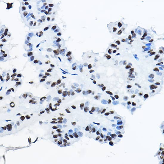 Immunohistochemistry: NONO Antibody [NBP3-38132] - Immunohistochemistry analysis of paraffin-embedded Human thyroid cancer using NONO Rabbit pAb at dilution of 1:100 (40x lens). High pressure antigen retrieval performed with 0.01M Citrate Bufferr (pH 6.0) prior to IHC staining.