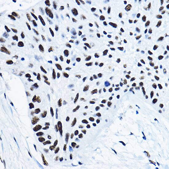 Immunohistochemistry: NONO Antibody [NBP3-38132] - Immunohistochemistry analysis of paraffin-embedded Human lung cancer using NONO Rabbit pAb at dilution of 1:100 (40x lens). High pressure antigen retrieval performed with 0.01M Citrate Bufferr (pH 6.0) prior to IHC staining.