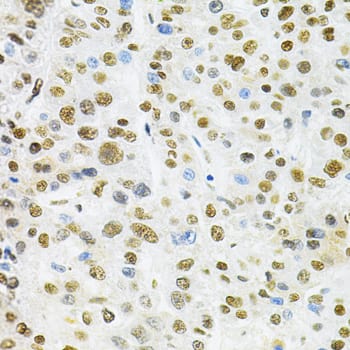 Immunohistochemistry: BAF57 Antibody [NBP3-38138] - Immunohistochemistry analysis of paraffin-embedded Human liver cancer using BAF57 Rabbit pAb at dilution of 1:200 (40x lens). Microwave antigen retrieval performed with 0.01M PBS Buffer (pH 7.2) prior to IHC staining.