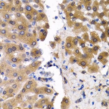 Immunohistochemistry: Sterol carrier protein 2 Antibody [NBP3-38141] - Immunohistochemistry analysis of paraffin-embedded Human liver cancer using Sterol carrier protein 2 Rabbit pAb at dilution of 1:200 (40x lens). Microwave antigen retrieval performed with 0.01M PBS Buffer (pH 7.2) prior to IHC staining.