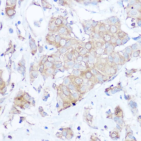 Immunohistochemistry: MGP Antibody [NBP3-38153] - Immunohistochemistry analysis of paraffin-embedded Human breast cancer using MGP Rabbit pAb at dilution of 1:100 (40x lens). High pressure antigen retrieval performed with 0.01M Citrate Bufferr (pH 6.0) prior to IHC staining.