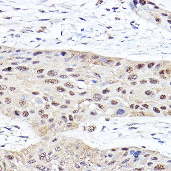 Immunohistochemistry: Proteasome 20S beta2 Antibody [NBP3-38161] - Immunohistochemistry analysis of paraffin-embedded Human esophageal cancer using Proteasome 20S beta2 Rabbit pAb at dilution of 1:100 (40x lens). High pressure antigen retrieval performed with 0.01M Citrate Bufferr (pH 6.0) prior to IHC staining.