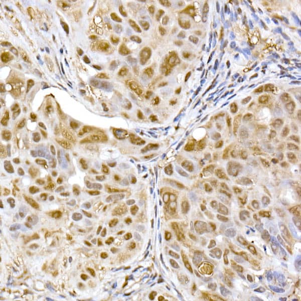 Immunohistochemistry: Proteasome 20S alpha 5 Antibody [NBP3-38181] - Immunohistochemistry analysis of paraffin-embedded Human colon carcinoma using Proteasome 20S alpha 5 Rabbit pAb at dilution of 1:50 (40x lens). High pressure antigen retrieval performed with 0.01M Citrate Bufferr (pH 6.0) prior to IHC staining.