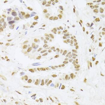 Immunohistochemistry: ANP32A Antibody [NBP3-38183] - Immunohistochemistry analysis of paraffin-embedded Human breast cancer using ANP32A Rabbit pAb at dilution of 1:100 (40x lens). Microwave antigen retrieval performed with 0.01M PBS Buffer (pH 7.2) prior to IHC staining.