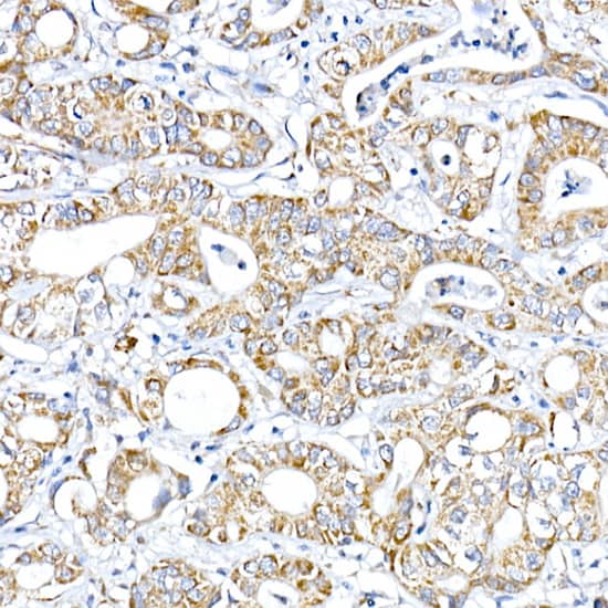 Immunohistochemistry: PTPIP51 Antibody [NBP3-38189] - Immunohistochemistry analysis of paraffin-embedded Human liver cancer using PTPIP51 Rabbit pAb at dilution of 1:100 (40x lens). High pressure antigen retrieval performed with 0.01M Citrate Bufferr (pH 6.0) prior to IHC staining.