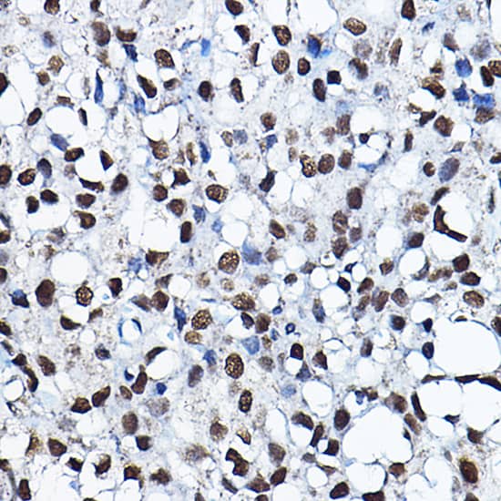 Immunohistochemistry: HBO1 Antibody [NBP3-38191] - Immunohistochemistry analysis of paraffin-embedded Human breast cancer using HBO1 Rabbit pAb at dilution of 1:100 (40x lens). Microwave antigen retrieval performed with 0.01M PBS Buffer (pH 7.2) prior to IHC staining.