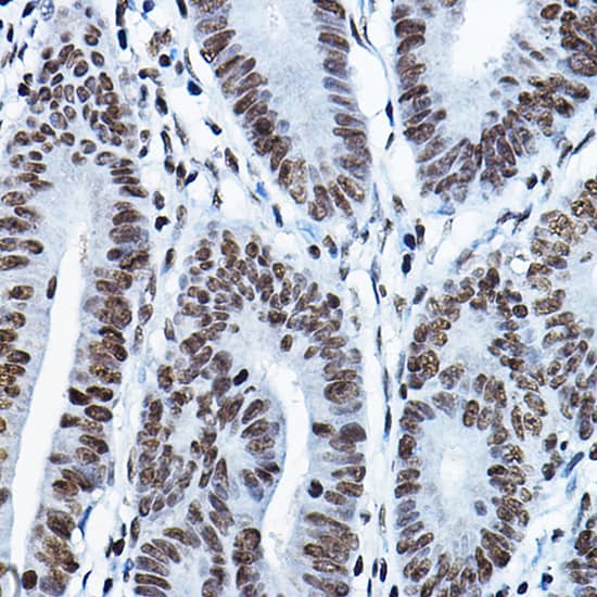 Immunohistochemistry: HBO1 Antibody [NBP3-38191] - Immunohistochemistry analysis of paraffin-embedded Human colon carcinoma using HBO1 Rabbit pAb at dilution of 1:100 (40x lens). Microwave antigen retrieval performed with 0.01M PBS Buffer (pH 7.2) prior to IHC staining.