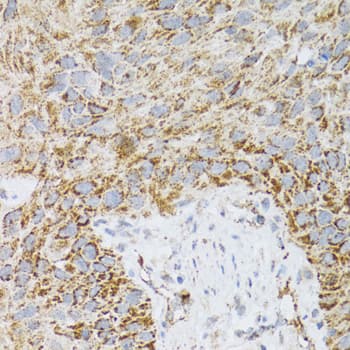 Immunohistochemistry: Prodynorphin/PDYN Antibody [NBP3-38195] - Immunohistochemistry analysis of paraffin-embedded Human lung cancer using Prodynorphin/PDYN Rabbit pAb at dilution of 1:100 (40x lens). Microwave antigen retrieval performed with 0.01M PBS Buffer (pH 7.2) prior to IHC staining.